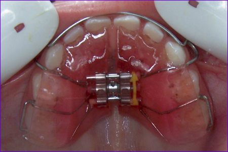 appareil orthodontique amovible plaque palatine avec vérin