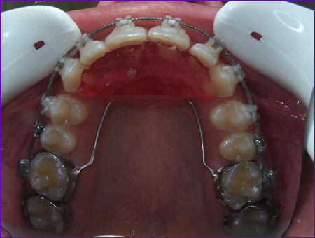 appareil orthodontique fixe : arc de Nance avec plan de surélévation rétro-incisif