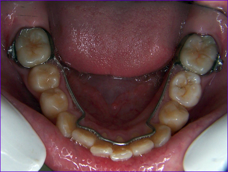 appareil orthodontique fixe:arc lingual bibague