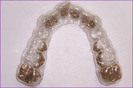 gouttiere-de-collage-indirect-attaches-orthodontie-linguale-Incognito
