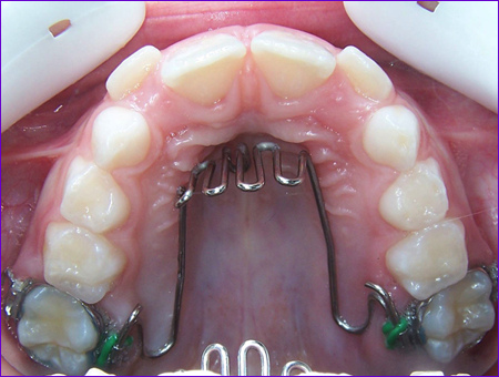 appareil-orthodontique-fixe-grille anti-pouce-anti-langue