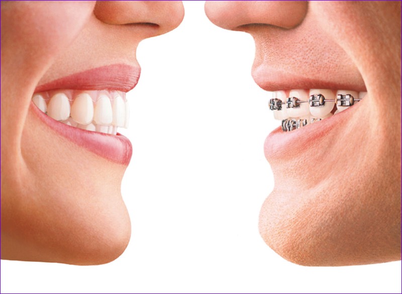 Comparaison de 2 sourires:avec aligneur transparent Invisalign et avec attaches métalliques