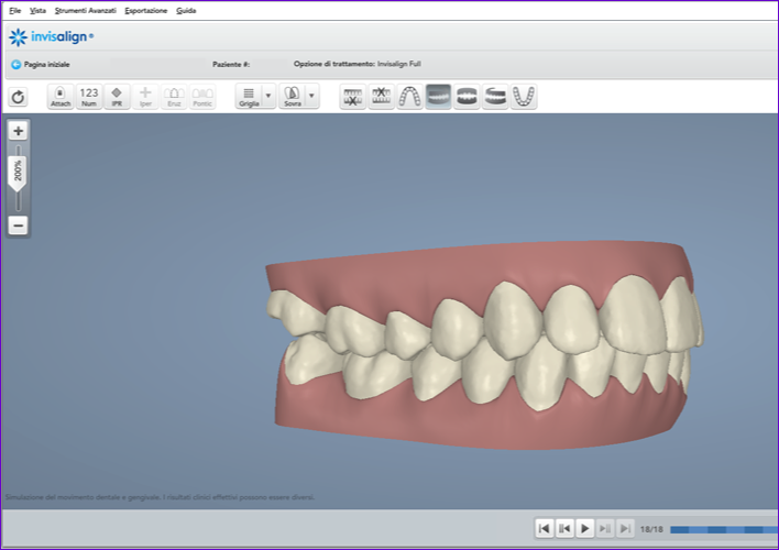 Previsionnel de traitement informatique 3D Invisalign : le Clincheck