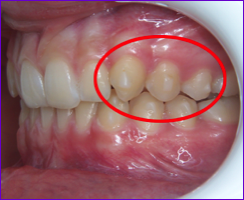 Taquets de résine composite utilisés pour optimiser certains mouvements dentaires avec les aligneurs Invisalign