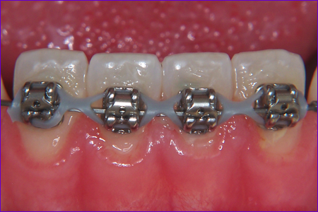 appareil orthodontique multiattache: Chainette d