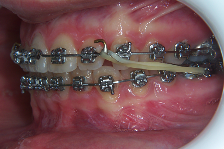 appareil orthodontique multiattache élastiques inter-maxillaires