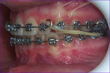 Modèle De Dent Avec Des Bagues Dentaires De Fil En Métal Photo stock -  Image du santé, dentisterie: 128694922