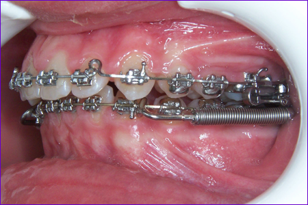 Appareil orthodontique : le Forsus pour correction du décalage des arcades dentaires