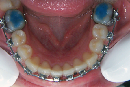 Orthodontie bagues attaches metal ceramique Cabinet Aveniortho