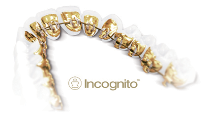 orthodontie linguale appareil Incognito