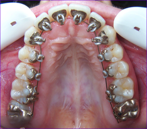 Orthodontie:technique linguale Appareillage Incognito de l
