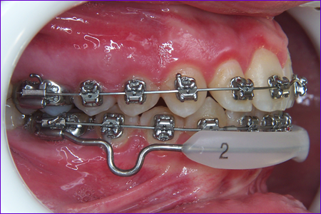 appareil orthodontique le Lip Bumper