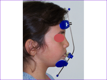 appareil orthodontique amovible:Masque facial de Delaire