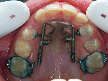 appareil orthodontique fixe : le DistalJet