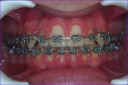 appareil orthodontique multiattaches avec attaches classiques et ligatures