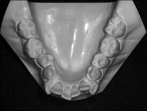 moulage-modele-orthodontique-taille-americaine-occlusal-mandibulaire