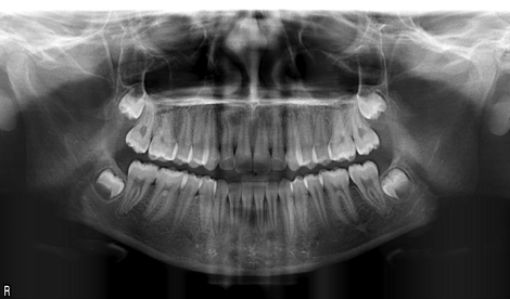 Radiographie panoramique d