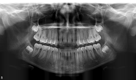 Le bilan première étape du traitement orthodontique.