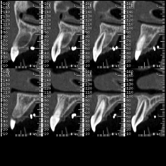 Scanner cone-beam-Coupe incisive