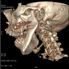 Scanner Cone Beam-reconstruction 3D mandibule