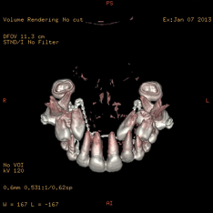 Scanner Cone Beam-Reconstruction 3D maxillaire