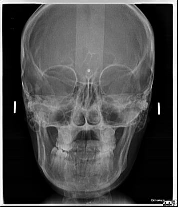 Teleradiographie de face