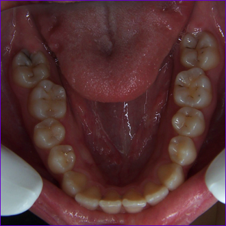 photo-vue-intrabuccale-occlusale-mandibulaire