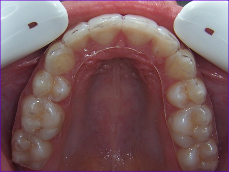 Orthodontie-Stabiliser le résultat du traitement: la contention.