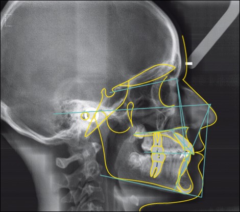 Orthodontie trace analyse cephalometrique