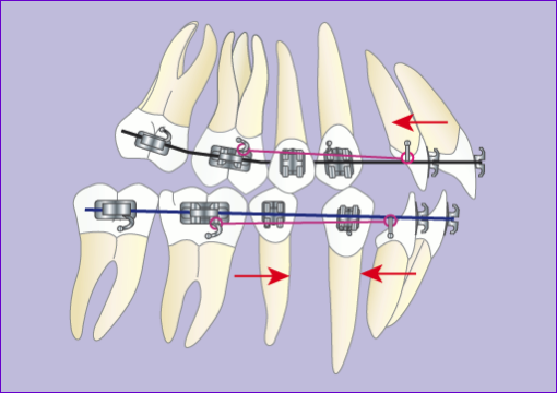 Orthodontie:Traitement multibague avec extraction 4 premolaires en 7images-phase 3
Orthodontie:Traitement multibague avec extraction 4 premolaires en 7images-phase 3
Orthodontie:Traitement multibague avec extraction 4 premolaires en 7images-phase 3