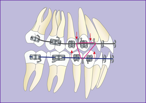 Orthodontie:Traitement multibague avec extraction 4 premolaires en 7images-phase 5