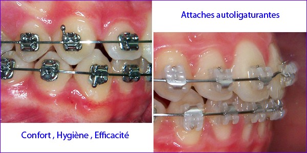 Attaches ou bagues orthodontiques auto-ligaturantes metalliques et ceramiques.