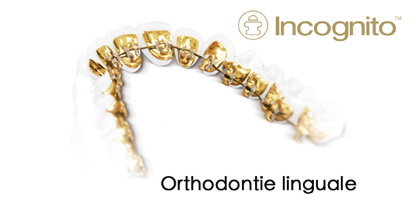 Orthodontie linguale : Appareil de la technique Incognito 