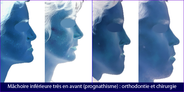 Profil avant et après chirurgie orthognatique de deux cas de prognatisme