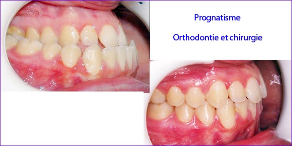 Vues intra-buccales :avant et après chirurgie orthognatique pour prognatisme