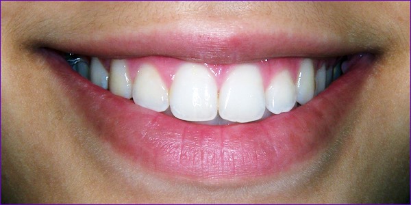 Orthodontie:sourire harmonieux en fin de traitement