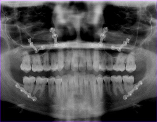 Radioggraphie panoramique avec plaques d