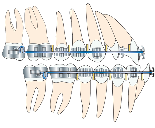 Prognatisme occlusion dentaire latérale après préparation orthodontique (décompensation)