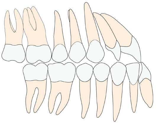Prognatisme occlusion dentaire latérale avant traitement
