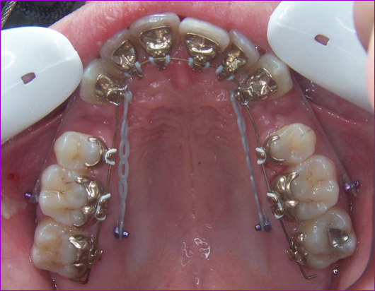 Interventions de Chirurgie buccale et traitement d'orthodontie.