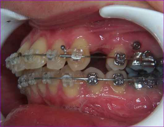 Le point sur les différentes techniques orthodontiques (fixes versus  aligneurs) : indications chez l'adulte et incidences parodontales –  L'Information Dentaire