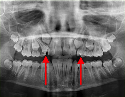 Radiographie panoramique montrant la nécessité d