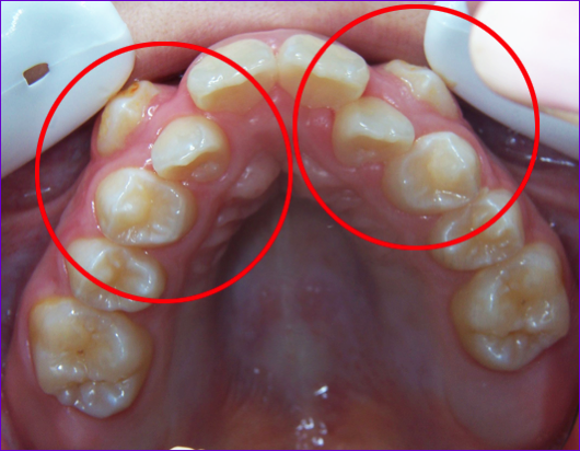 Fort encombrement dentaire maxillaire justifiant des extractions de prémolaires