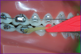 Orthodontie multiattache multibagues mettre les elastiques intermaxillaires-etape 2