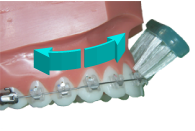 brossage dentaire avec appareil orthodontique-multiattache ou bagues-étape 5