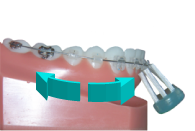 brossage dentaire avec appareil orthodontique-multiattache ou bagues-étape 4