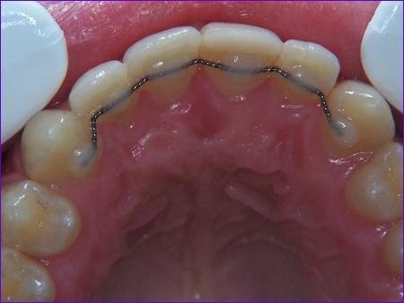 Attelle-linguale-de-contention-orthodontique-collee-face-interne-incisives-et-canines-superieures