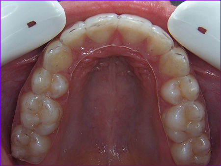 Orthodontie-gouttiere-transparente-de-contention