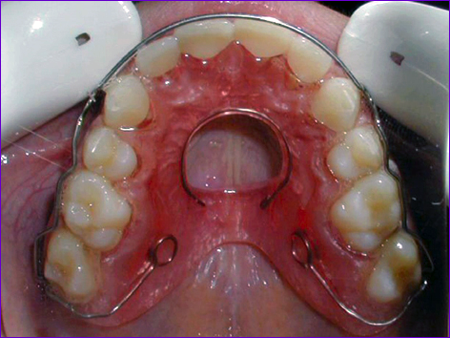 plaque-de-contention orthodontique-dite-plaque-Alexander