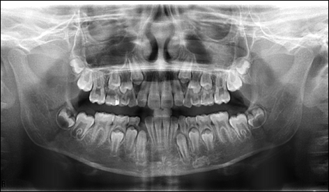 radiographie-panoramique-denture-mixte